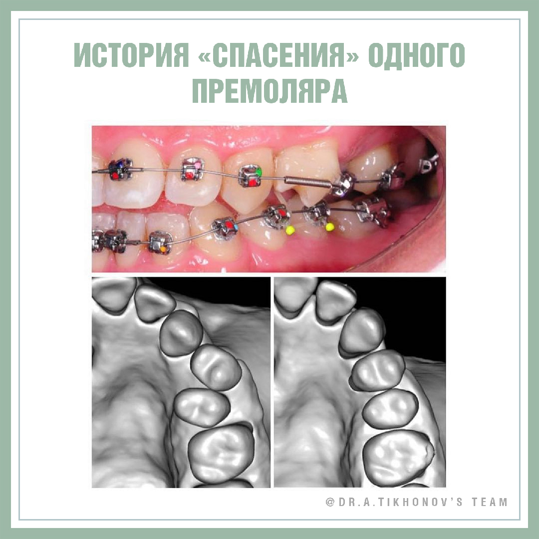 История «спасения» одного премоляра. - интересно об ортодонтии, имплантации  и протезировании зубов